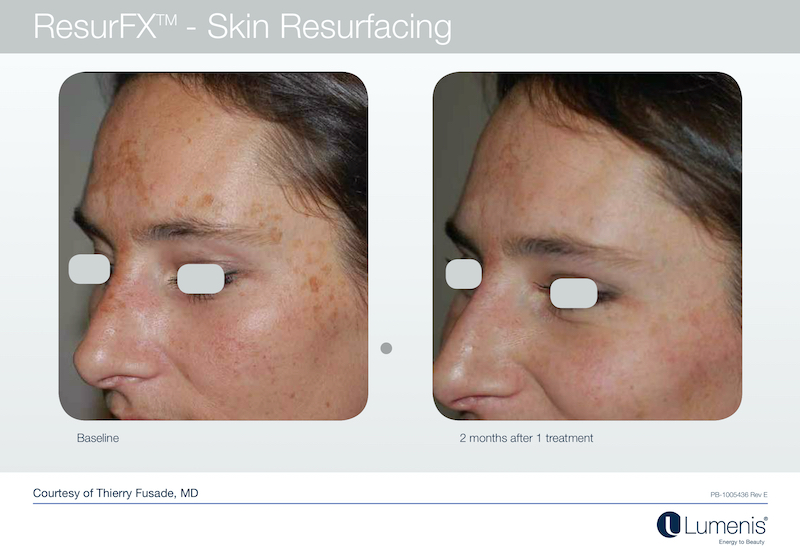 Before and After ResurFX Skin Resurfacing