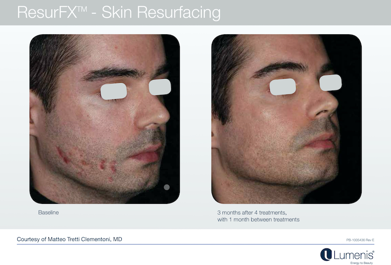 Before and After ResurFX Skin Resurfacing